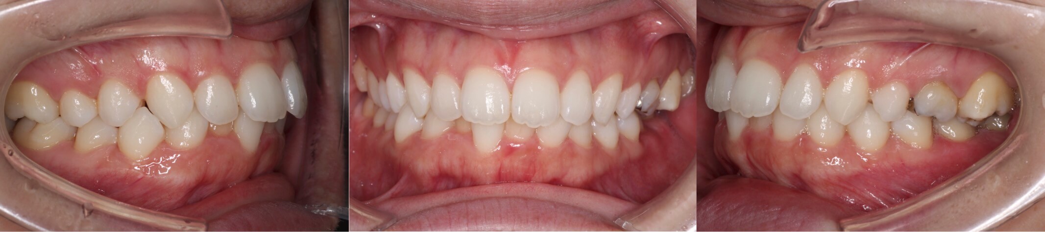 インビザライン・乳歯抜歯治療例