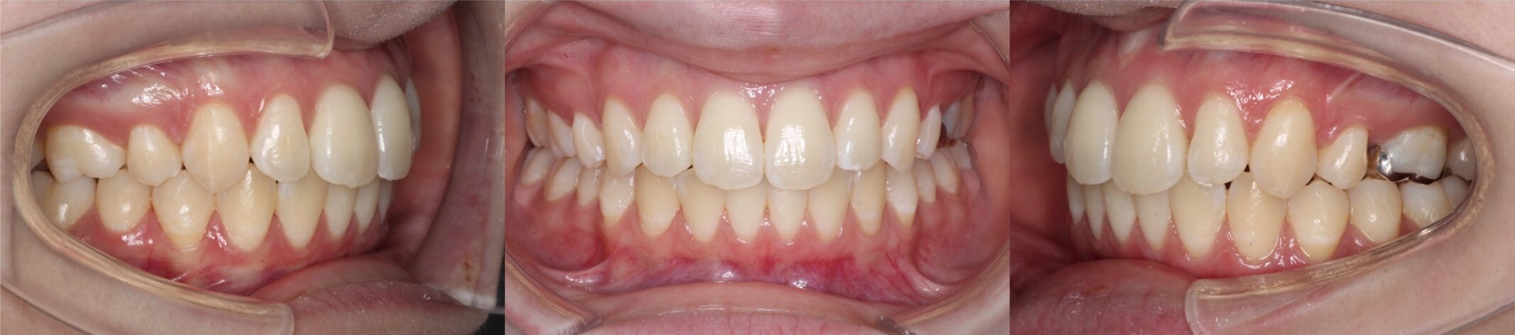 インビザライン・上顎前突抜歯症例