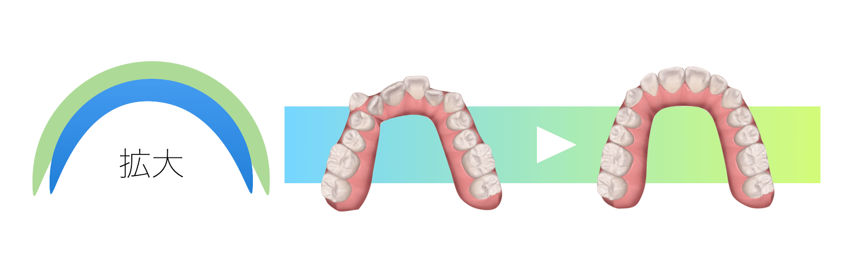 矯正治療奥歯の歯列拡大方針