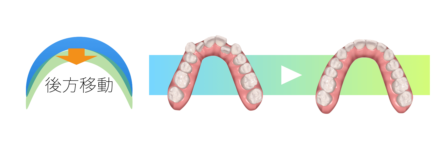 矯正治療奥歯の後方移動方針