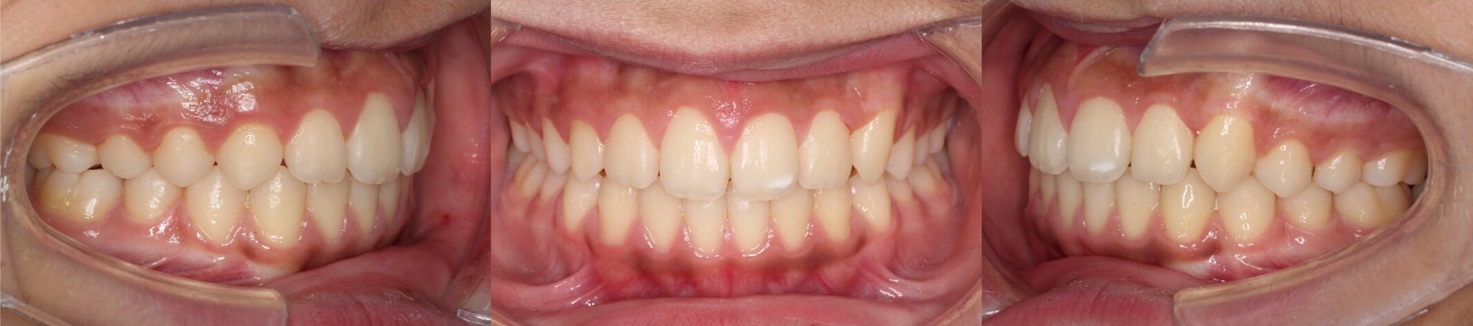 インビザライン治療例・小学生・八重歯