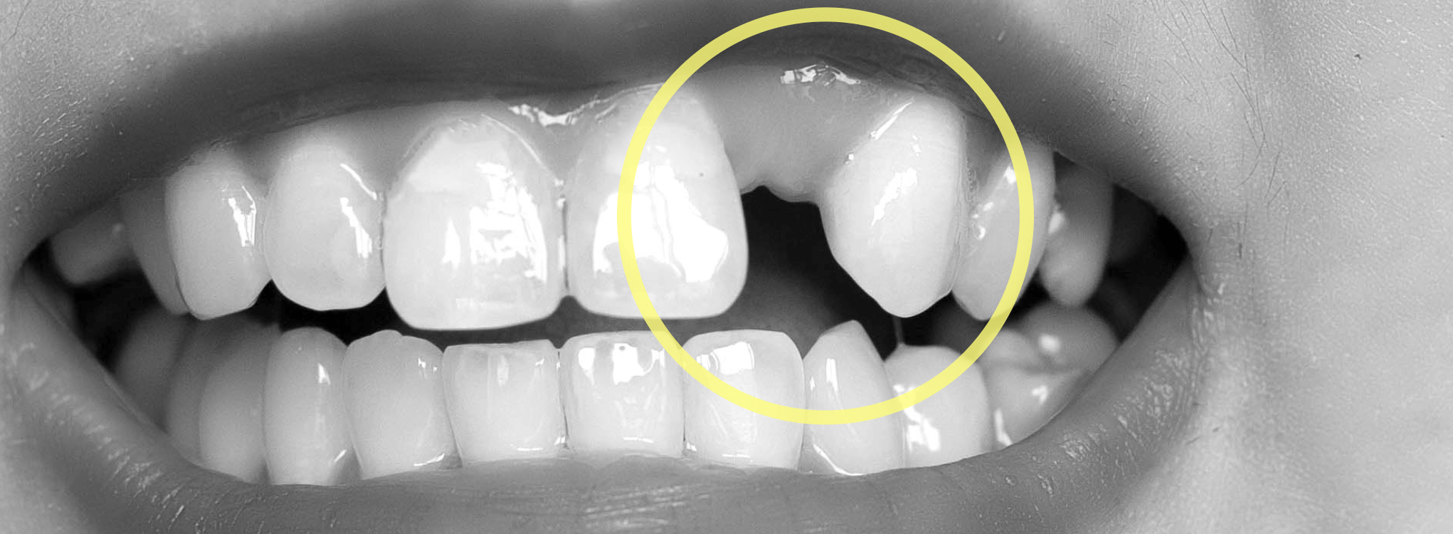 先天性欠如歯や欠損歯がある矯正治療