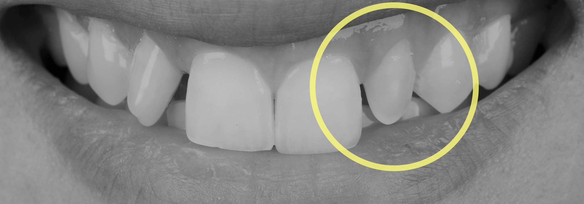 歯が小さい場合の矯正治療