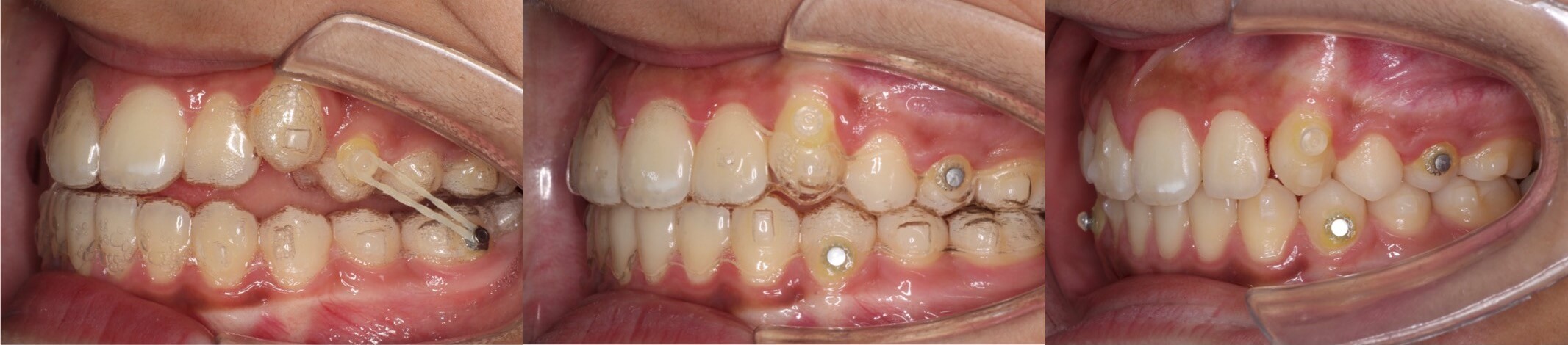 インビザライン治療例・小学生・八重歯