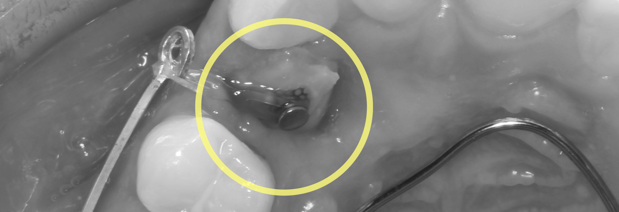 埋伏歯の矯正治療