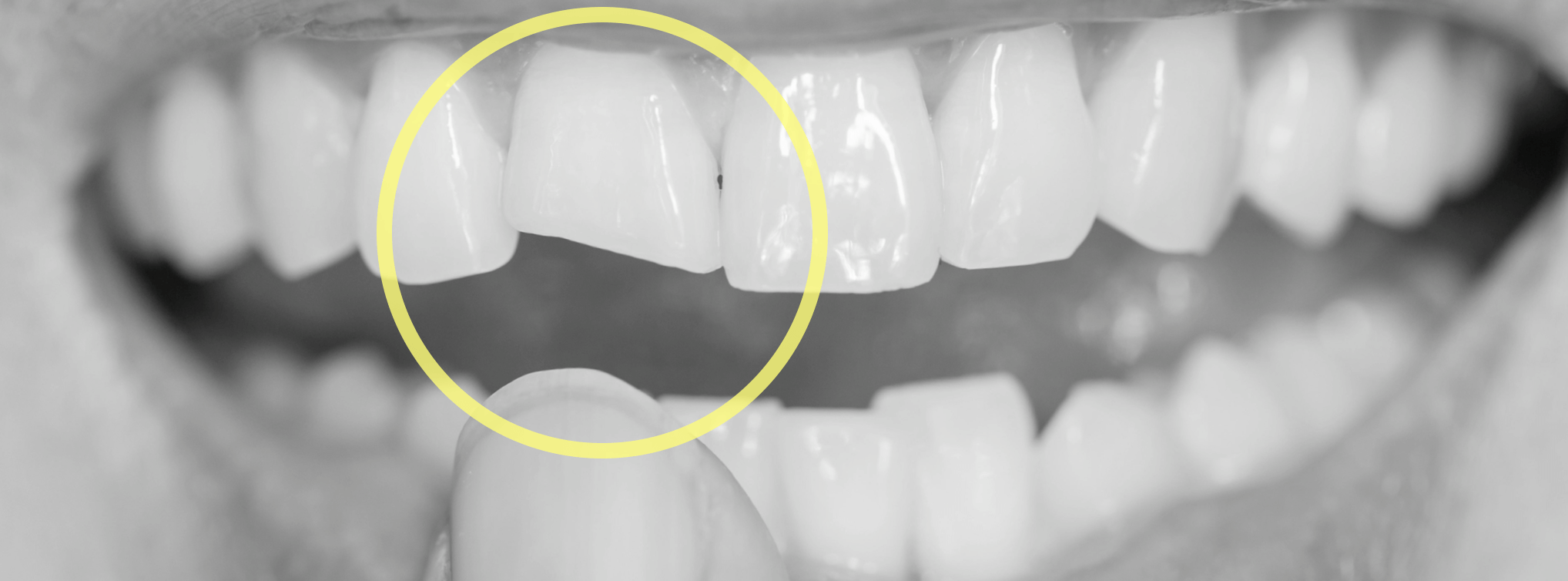 歯の形が良くない矯正治療