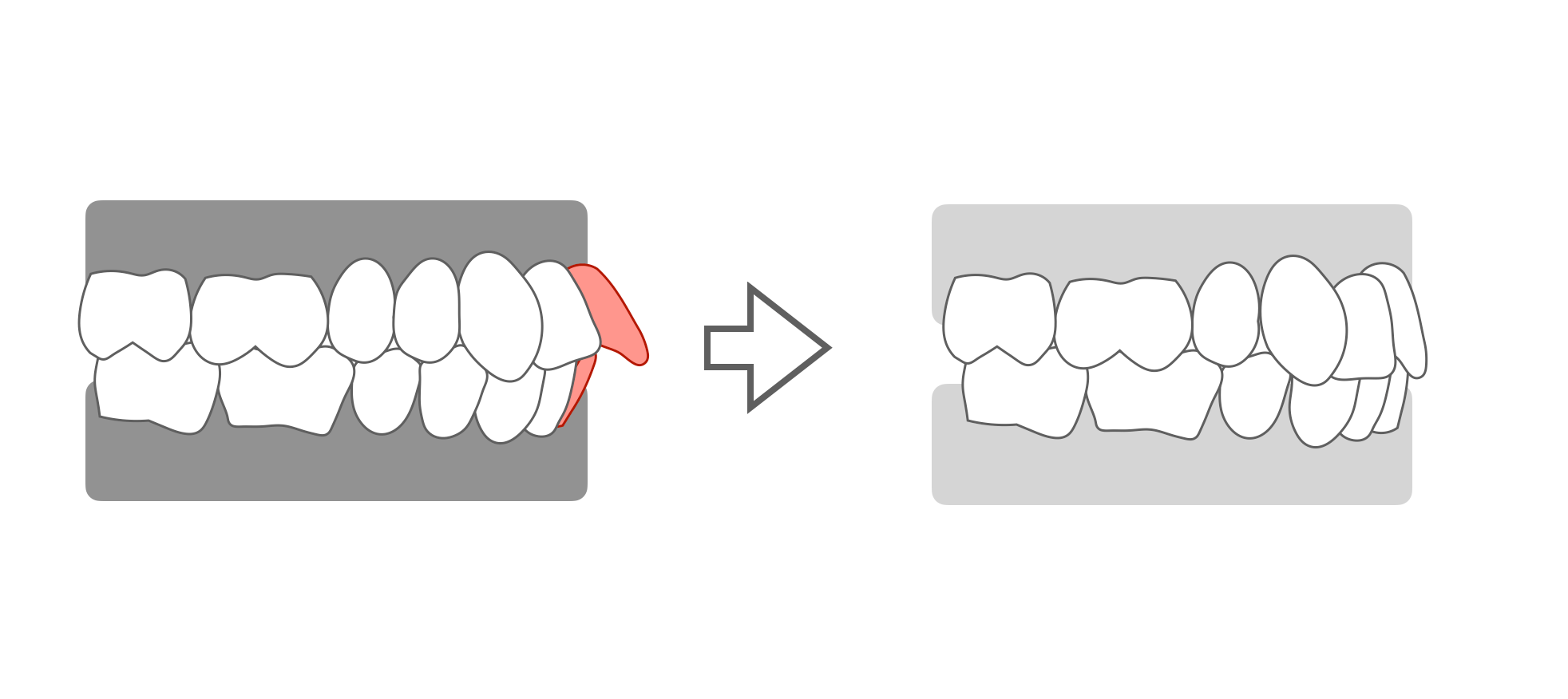 抜歯矯正による前歯の位置の変化