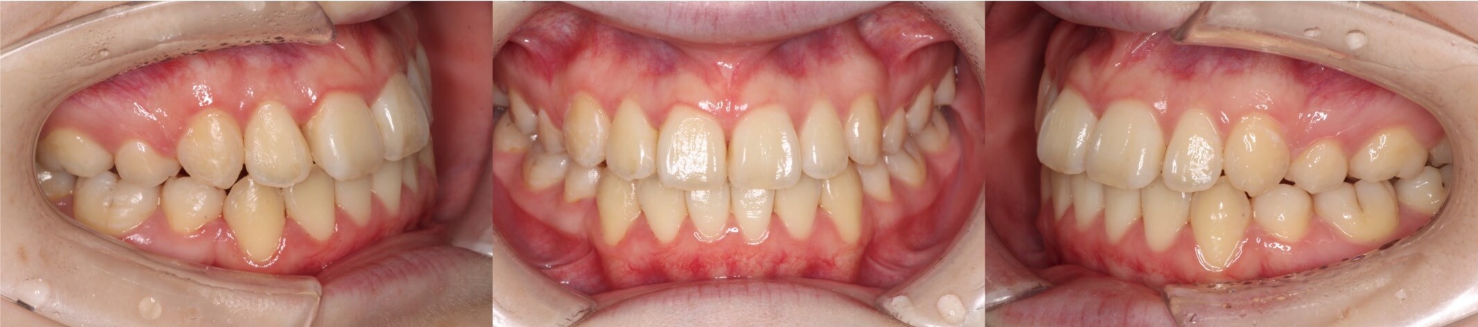 インビザライン・抜歯治療例
