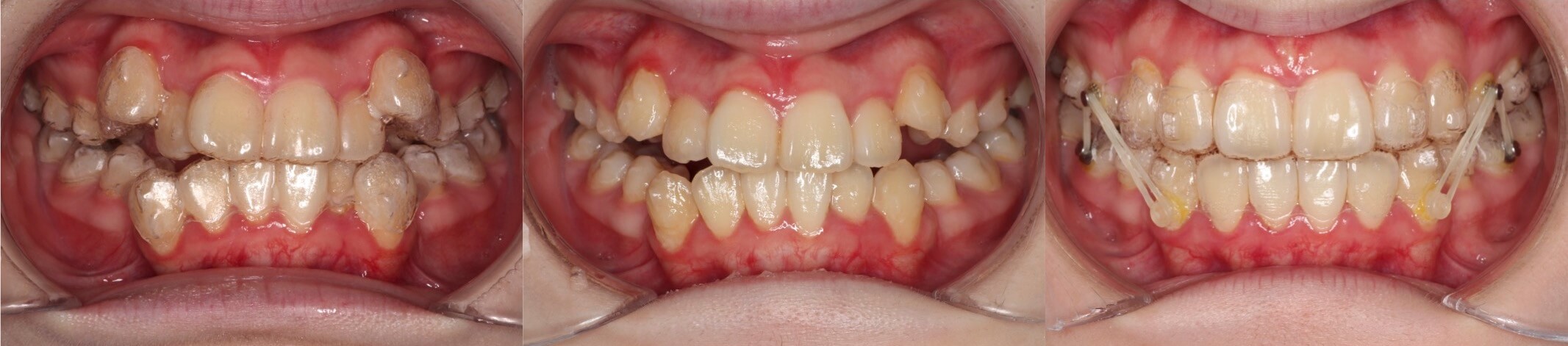 インビザライン・抜歯治療例
