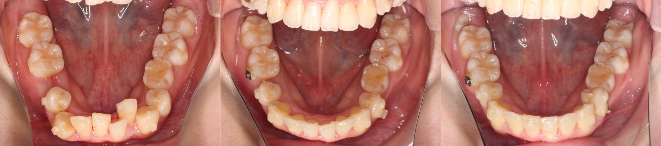 乳歯残存・インビザライン治療例