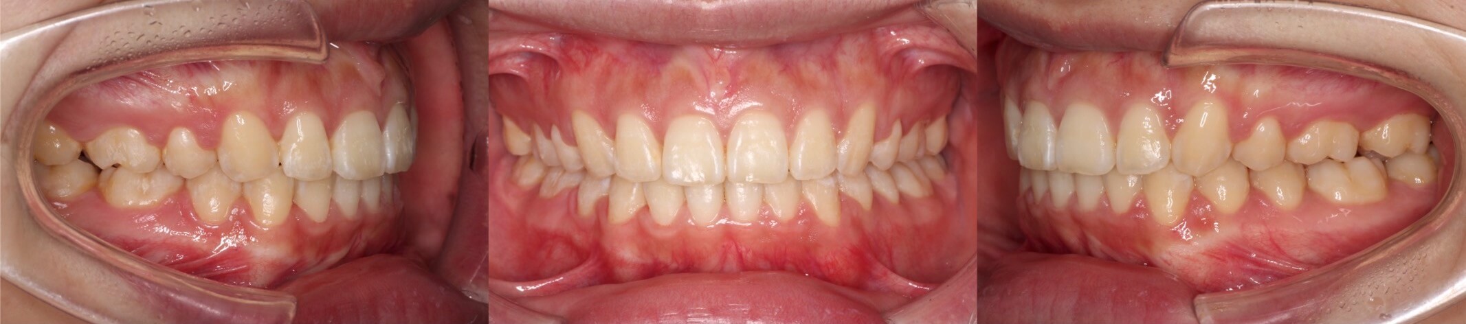 3本抜歯矯正治療例