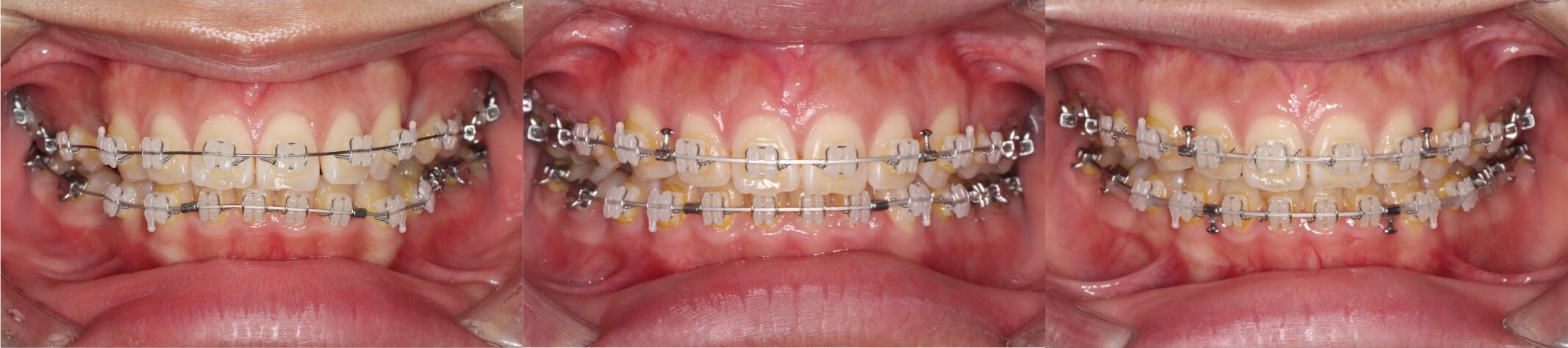 3本抜歯矯正治療例