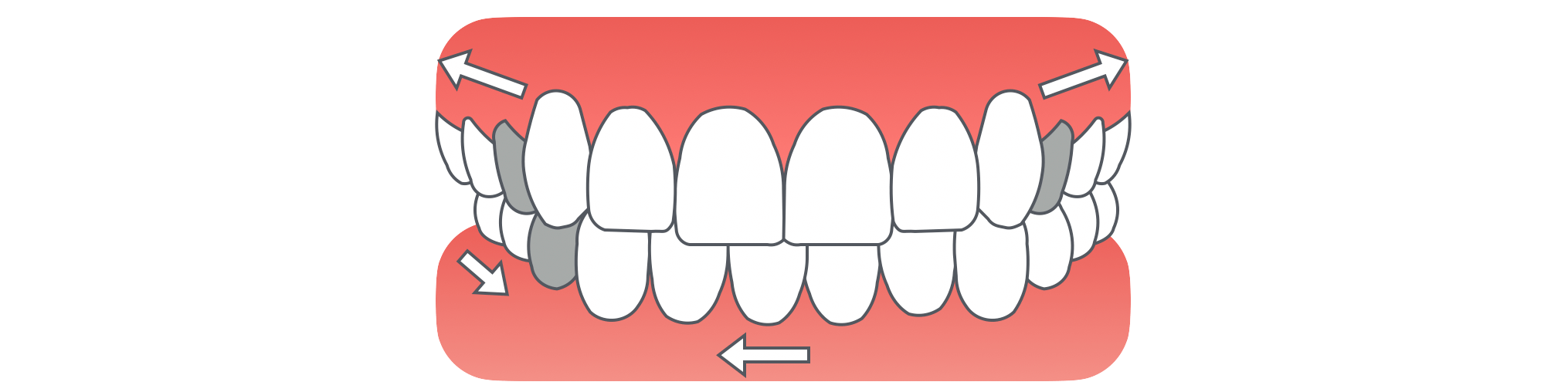 小臼歯3本抜歯
