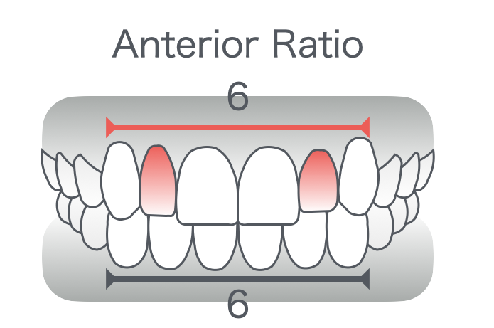 矮小歯ある際のアンテリアレイシオ