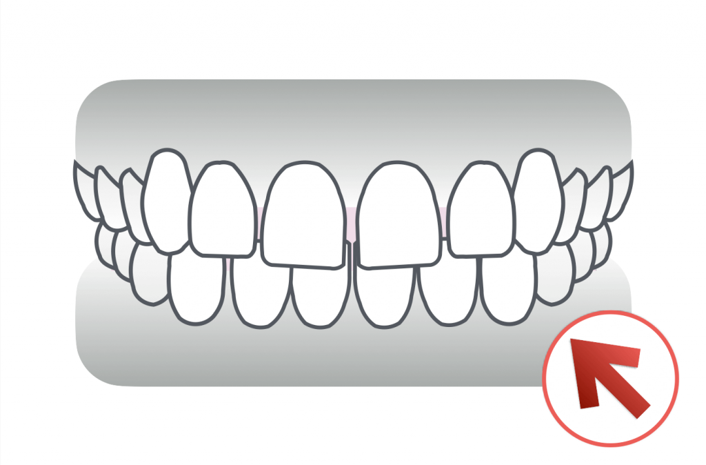 すきっ歯（空隙歯列）の矯正治療