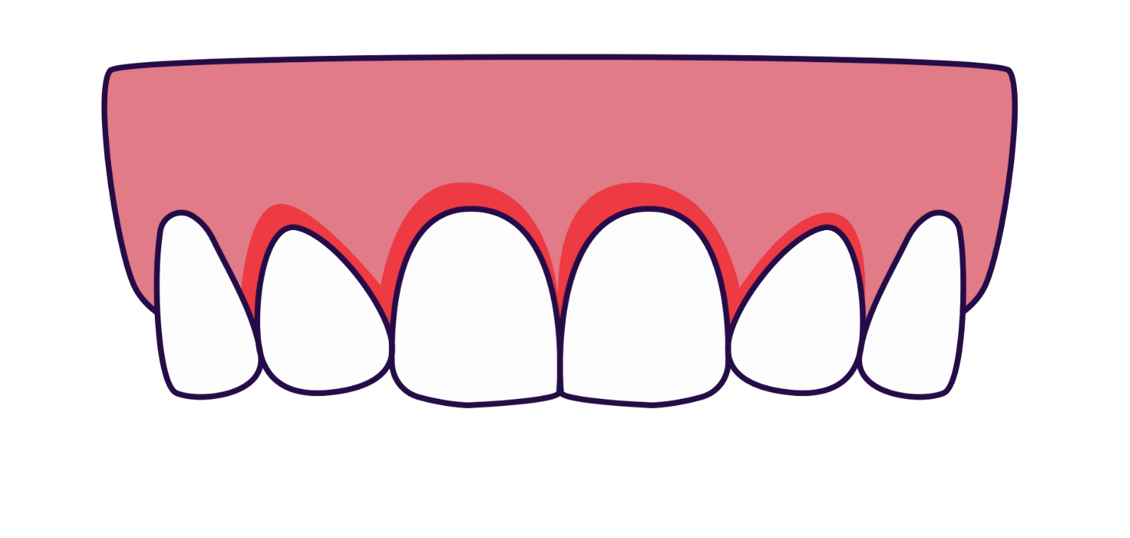 歯磨きが良くない方は矯正装置が外れる。