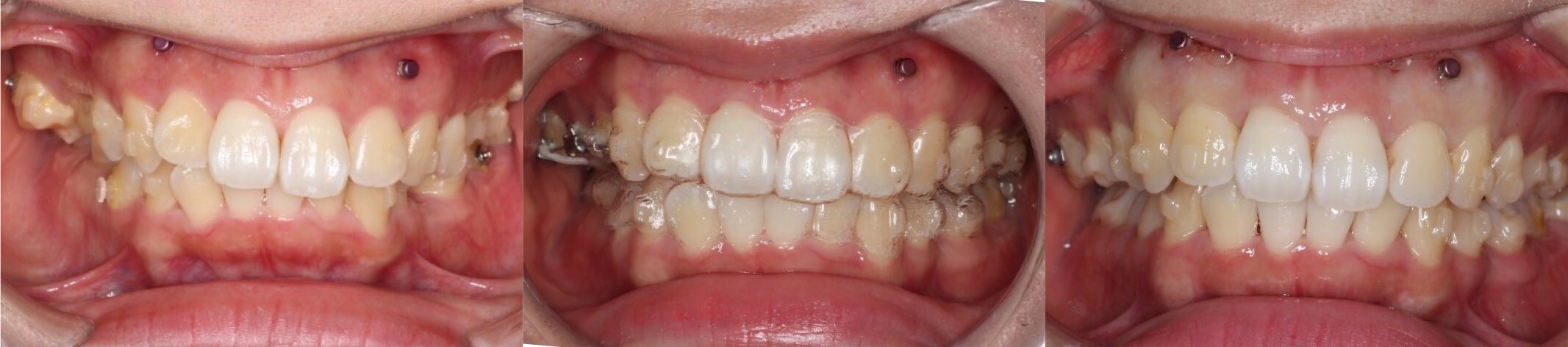 上下あご傾斜タイプの矯正治療