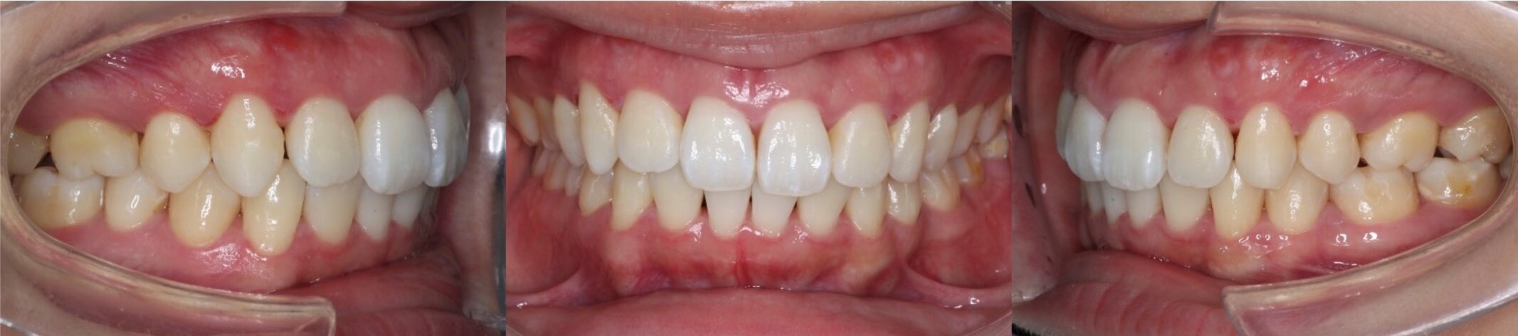 上下あご傾斜タイプの矯正治療