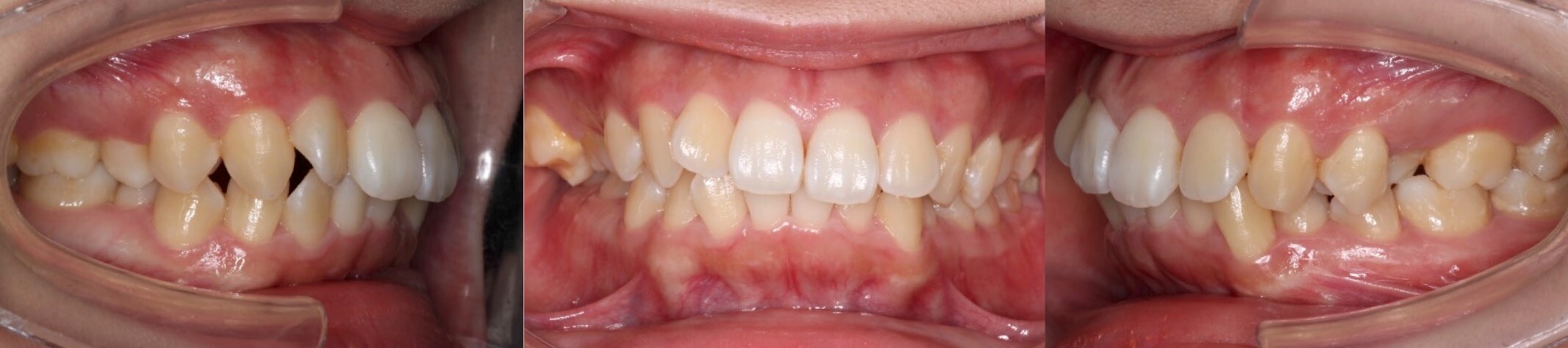 上下あご傾斜タイプの矯正治療