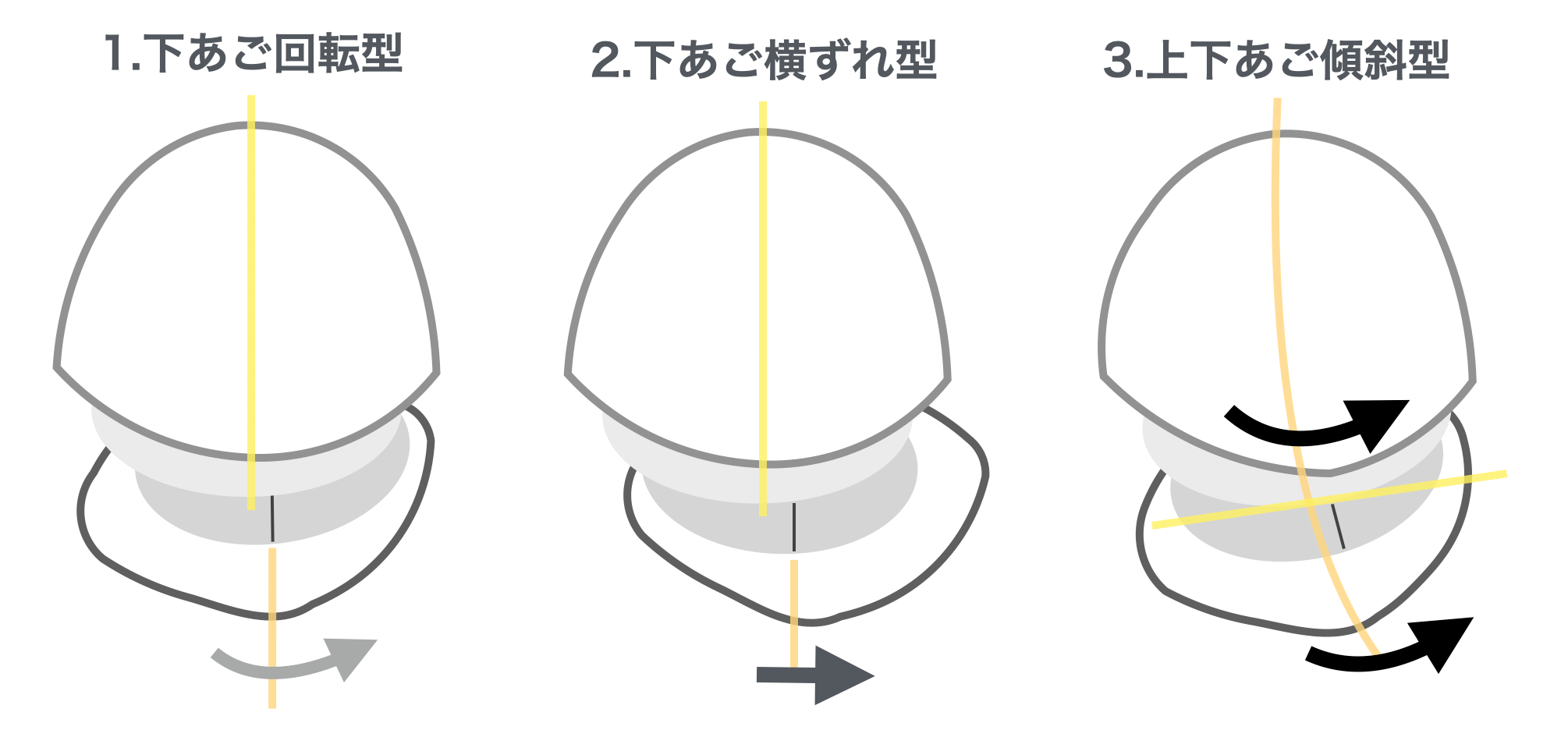 下あごのずれ方・非対称のタイプ