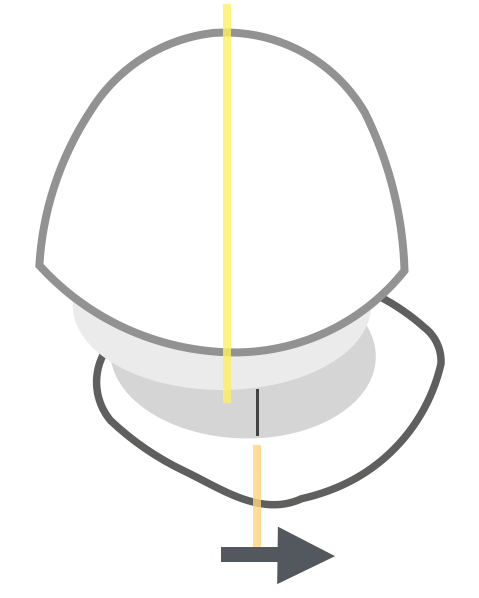 非対称・下あご横ずれタイプ(シフト)
