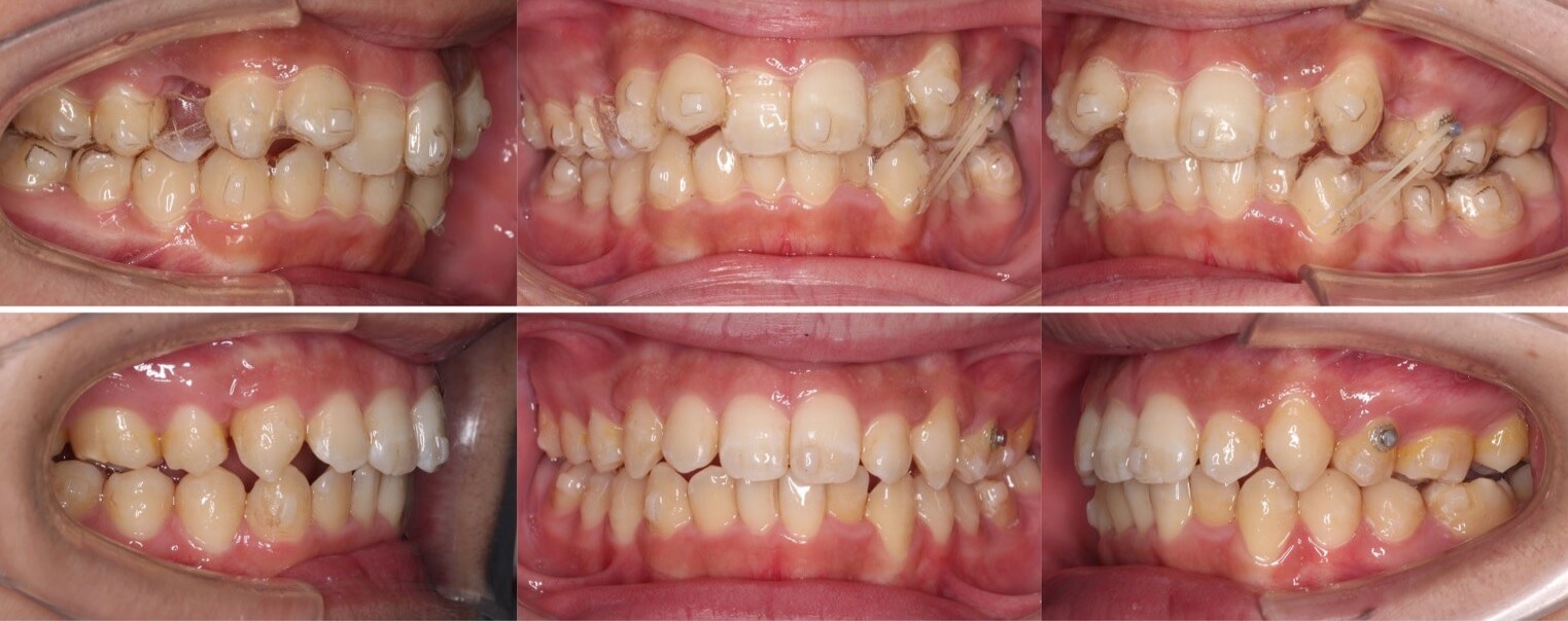 矯正治療例・大学生男性・八重歯・マウスピース型装置・抜歯