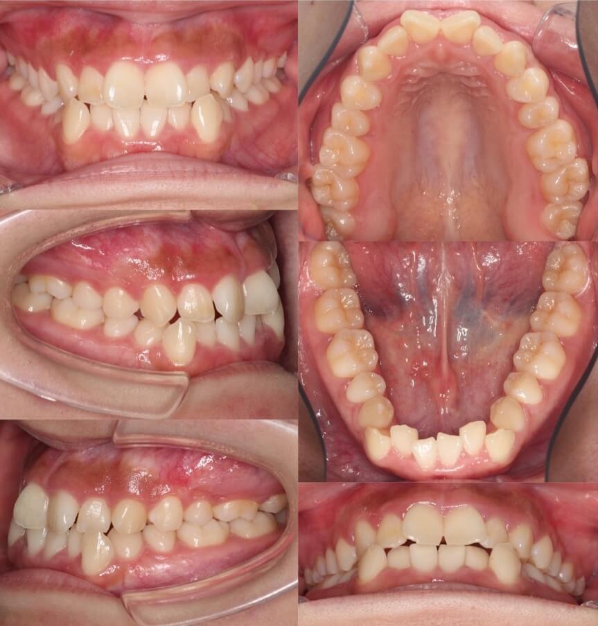 矯正治療例・大学生女性・八重歯・マウスピース型装置・非抜歯