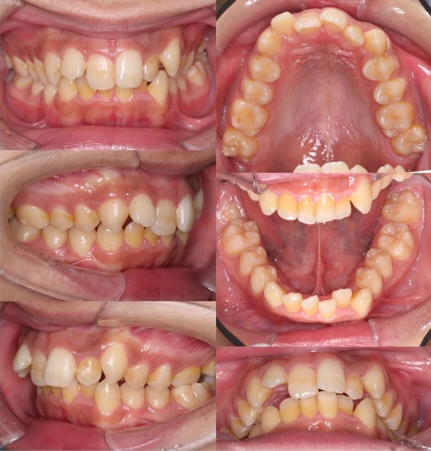 矯正治療例・大学生男性・八重歯・マウスピース型装置・抜歯