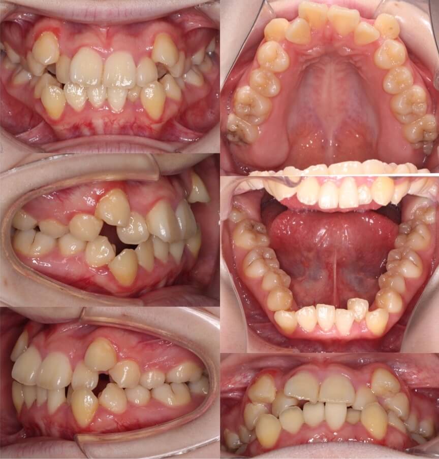 矯正治療例・高校生女性・八重歯・マウスピース型装置・抜歯