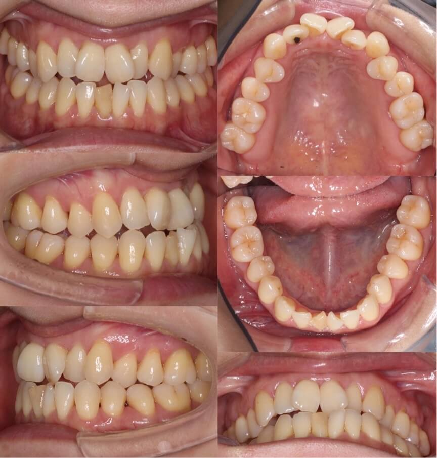 矯正治療例・40歳女性・マウスピース型矯正装置