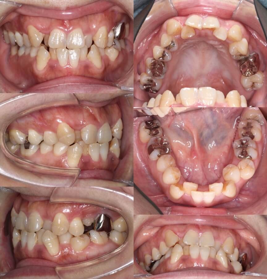 矯正治療例・43歳女性・唇側矯正装置・抜歯