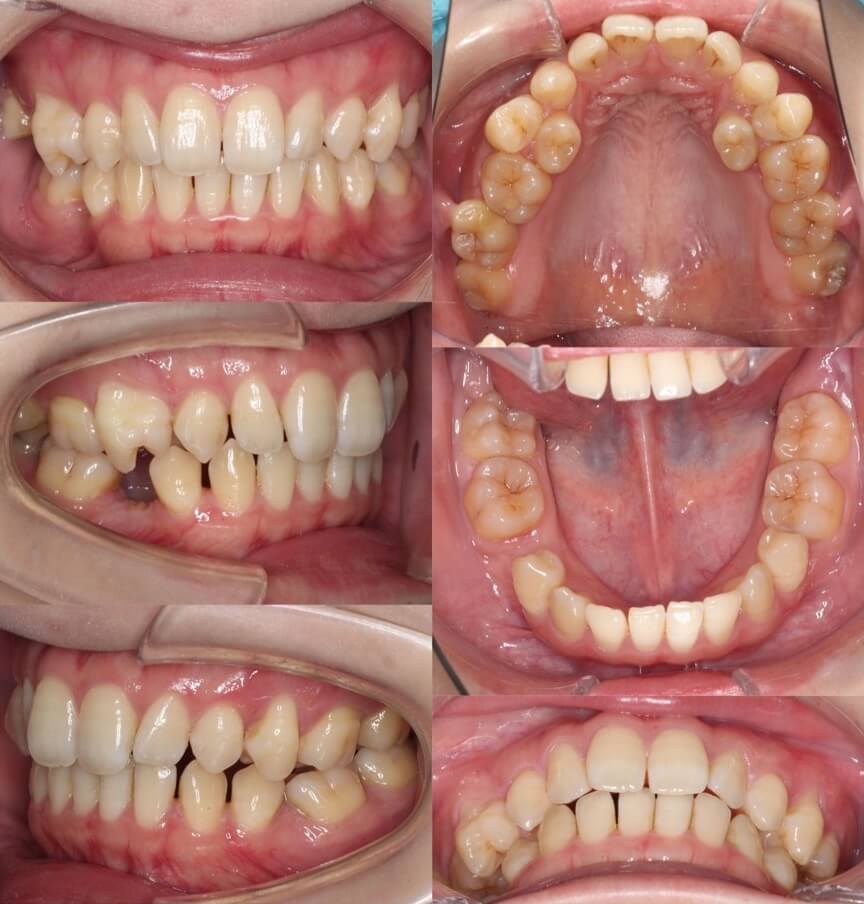 矯正治療例・20代女性・先天性欠損2歯・下5欠損