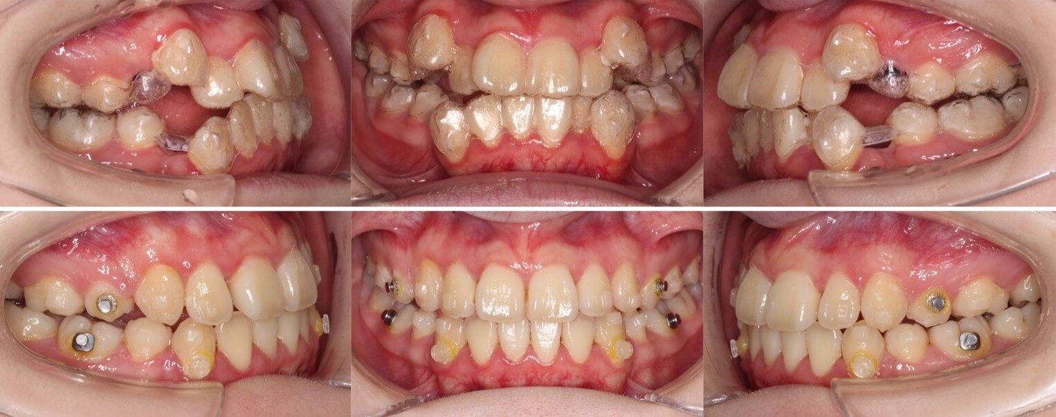 矯正治療例・高校生女性・八重歯・マウスピース型装置・抜歯