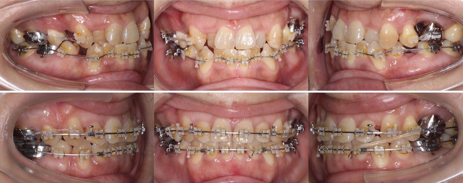 矯正治療例・43歳女性・唇側矯正装置・抜歯
