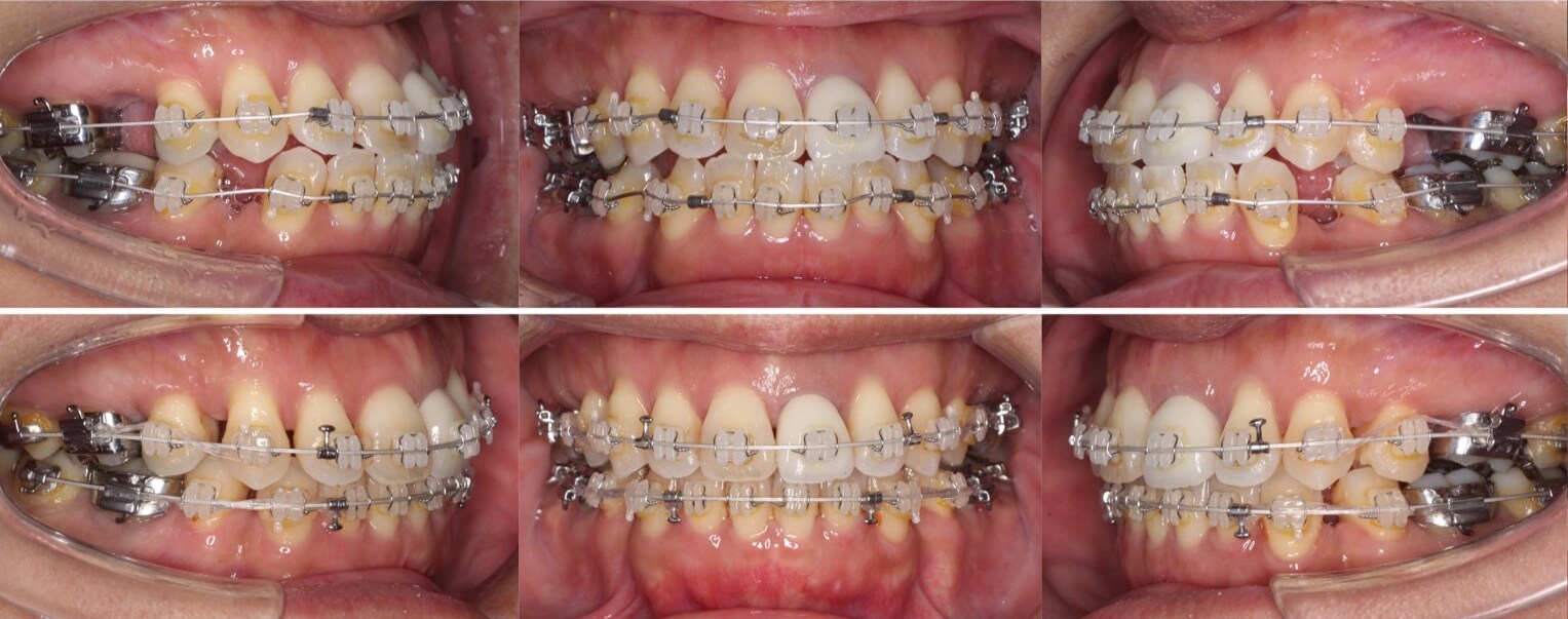 矯正治療例・46歳女性・唇側矯正装置・抜歯