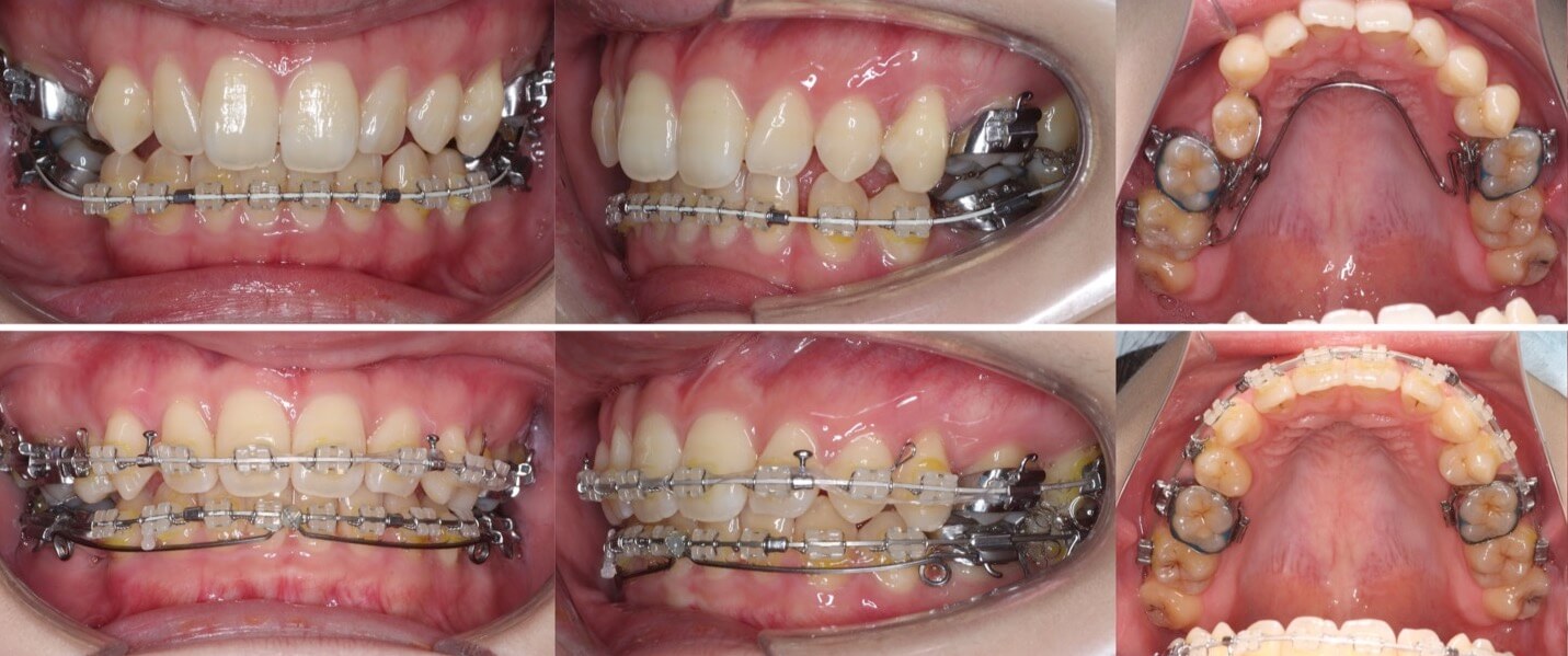矯正治療例・20代女性・先天性欠損2歯・下5欠損