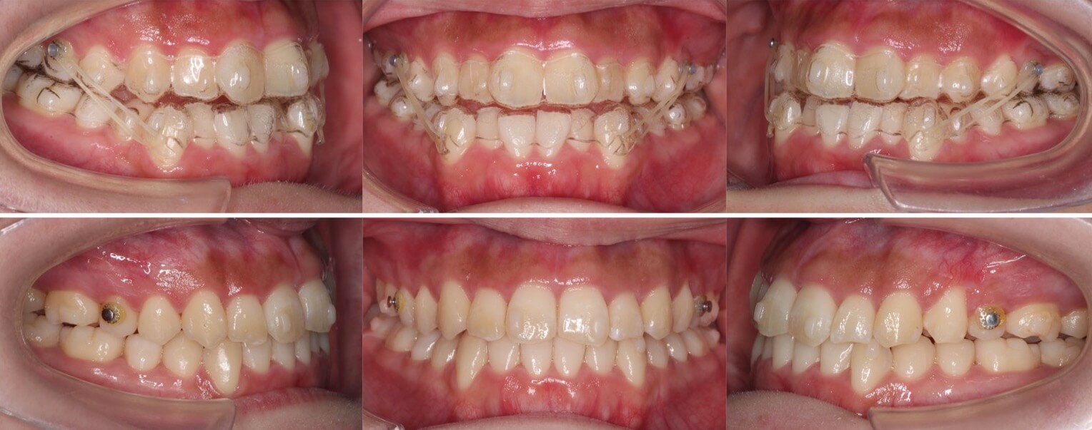 矯正治療例・大学生女性・八重歯・マウスピース型装置・非抜歯