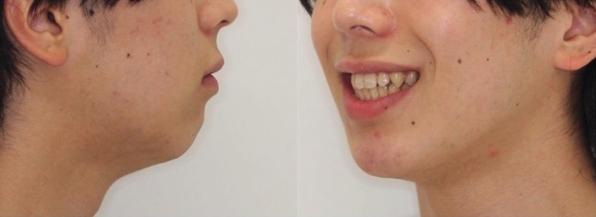 矯正治療例・大学生男性・八重歯・マウスピース型装置・抜歯