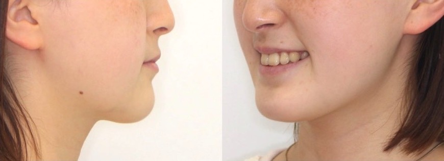 矯正治療例・高校生女性・八重歯・マウスピース型装置・抜歯