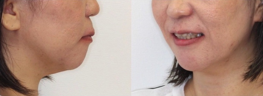 矯正治療例・43歳女性・唇側矯正装置・抜歯