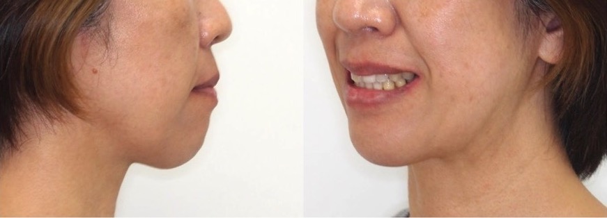 矯正治療例・46歳女性・唇側矯正装置・抜歯