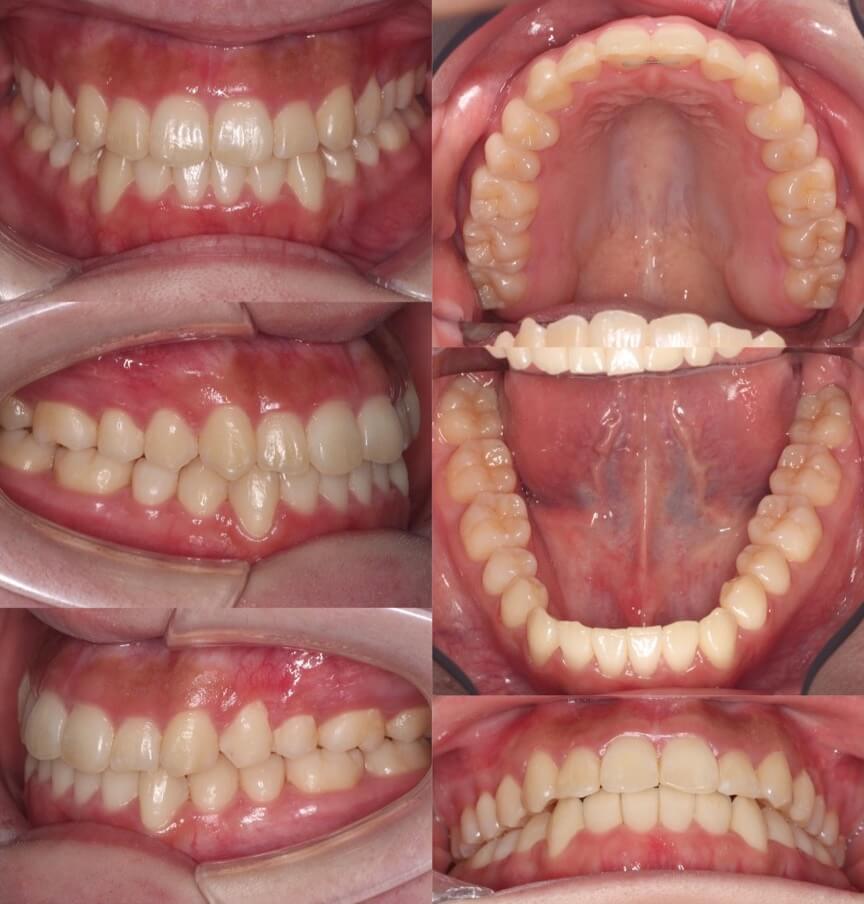矯正治療例・大学生女性・八重歯・マウスピース型装置・非抜歯
