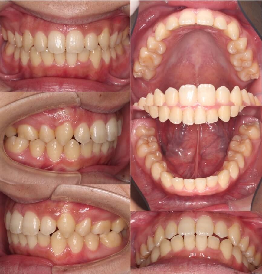矯正治療例・大学生男性・八重歯・マウスピース型装置・抜歯