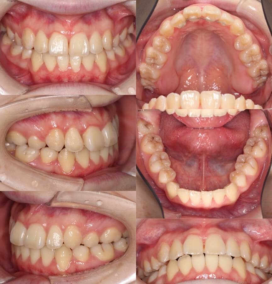 矯正治療例・高校生女性・八重歯・マウスピース型装置・抜歯