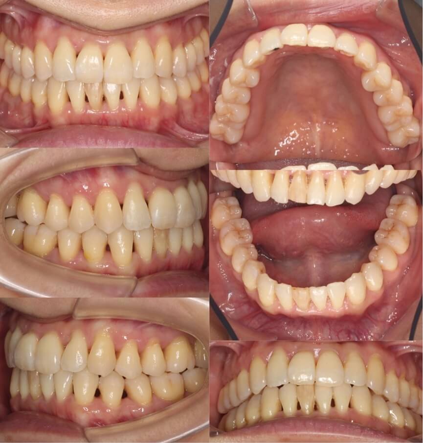 矯正治療例・40歳女性・マウスピース型矯正装置