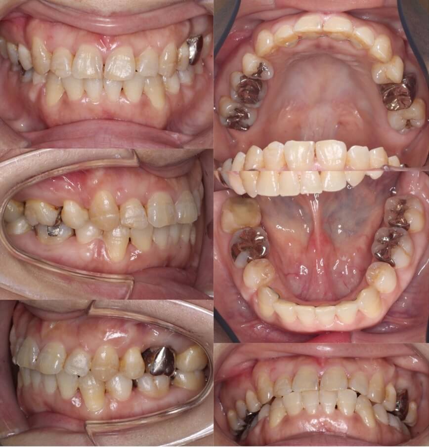 矯正治療例・43歳女性・唇側矯正装置・抜歯