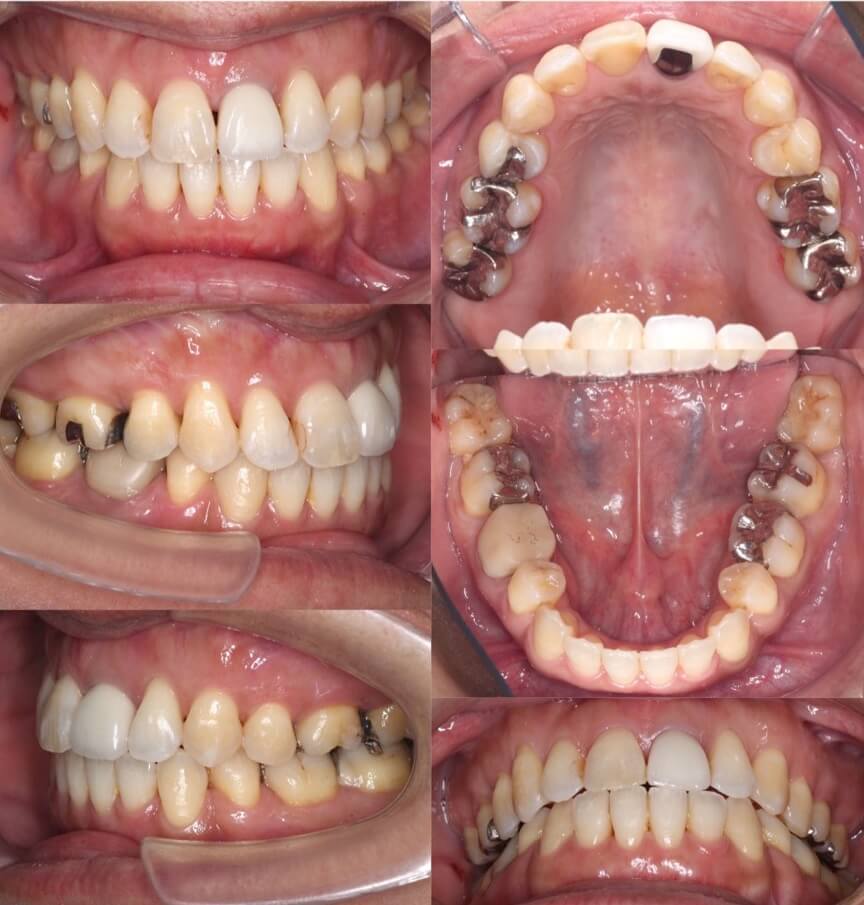 矯正治療例・46歳女性・唇側矯正装置・抜歯
