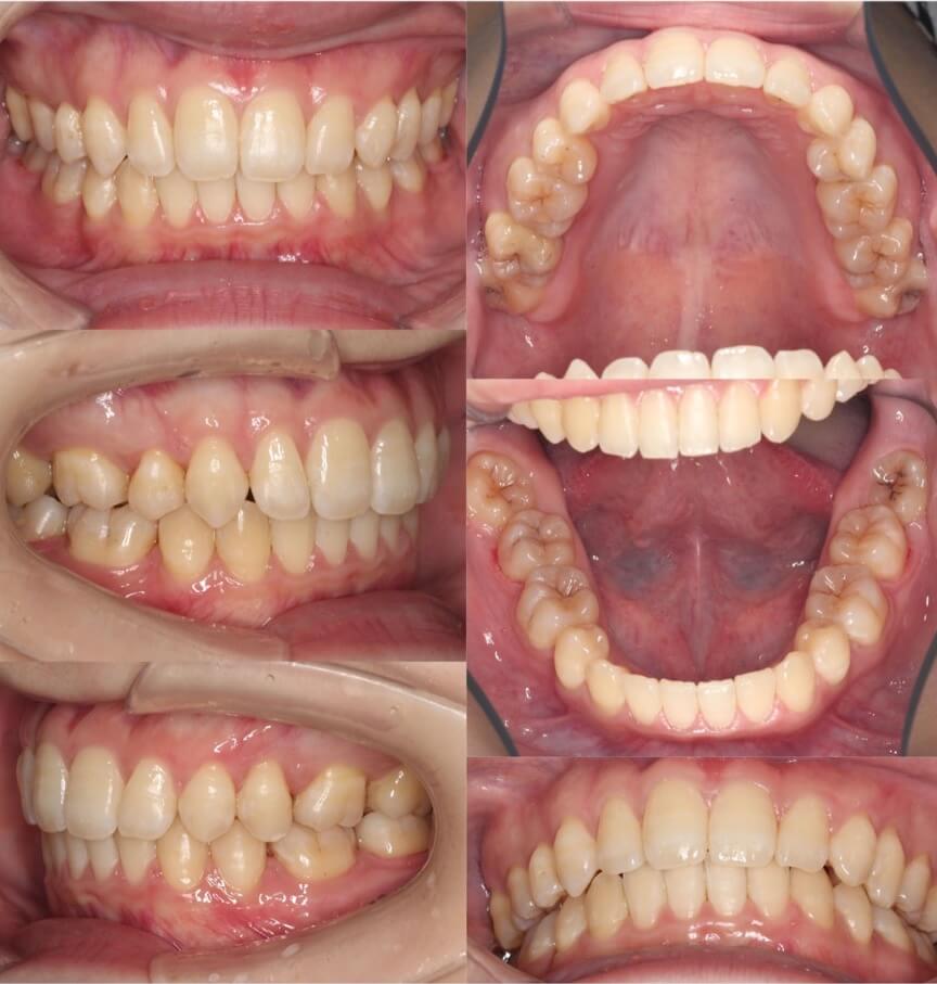 矯正治療例・20代女性・先天性欠損2歯・下5欠損