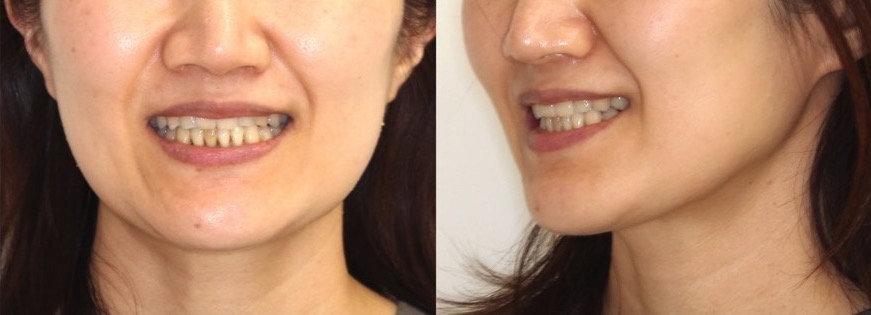 矯正治療例・40歳女性・マウスピース型矯正装置