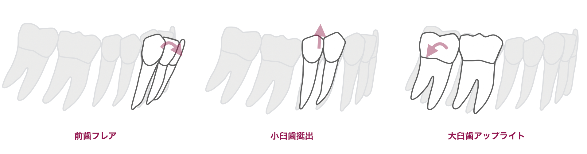 スピーカーブの解消方法